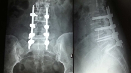 Spine-surgery