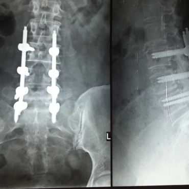 Spine-surgery